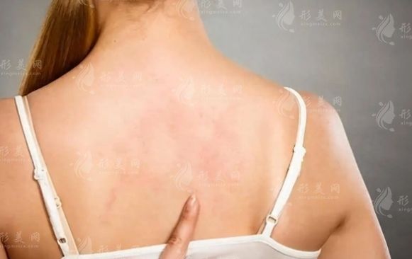 背部吸脂：常識、風險與并發(fā)癥