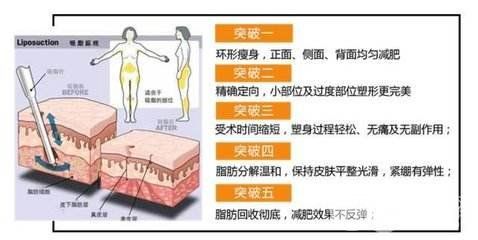 360吸脂
