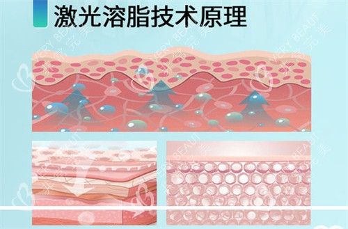 激光溶脂原理