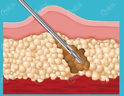 杭州做腰腹吸脂厲害的林中泵醫(yī)生采用針口小的吸脂針