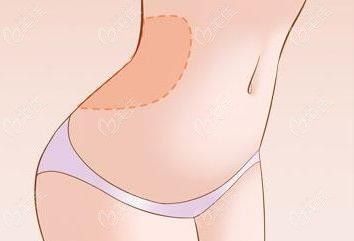 杭州做腰腹吸脂哪個醫(yī)生好？