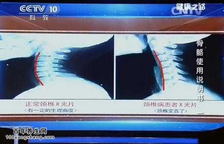 颈椎在长期静力下会造成损害
