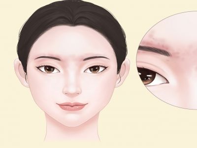 激光美白有副作用嗎 如何應(yīng)對激光美白帶來的副作用