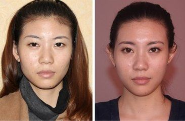 王紅錦徒手整形-面部整形,五官精雕,臉型塑造,手法培訓(xùn)班