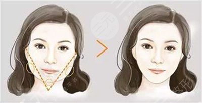 何照华磨骨案例