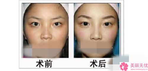 芜湖纹眉纹眼线手术费用影响因素有哪些