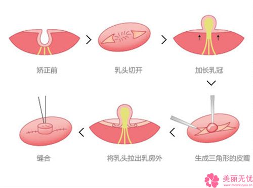 男人乳頭凹陷連云港市哪家醫(yī)院好(江蘇省連云港市第一人民醫(yī)院東方醫(yī)院機(jī)構(gòu)公立私立都有)