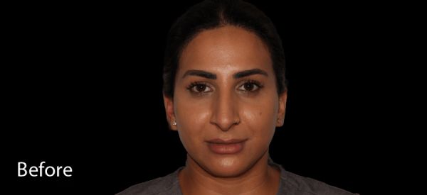 Ultherapy Before Treatment
