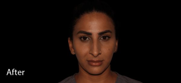 Ultherapy After Treatment