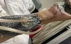 上班6天誤觸輻射源小伙：即將面臨截肢