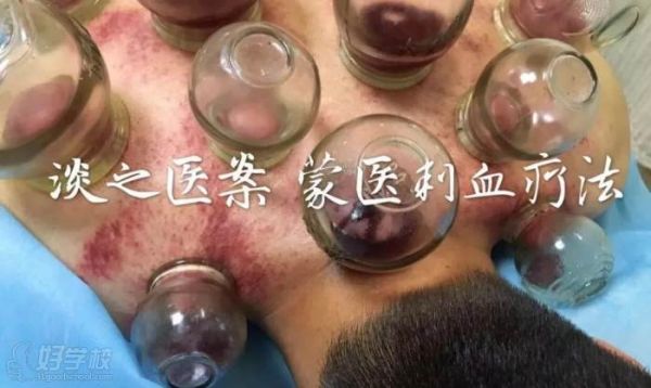 蒙医刺血疗法