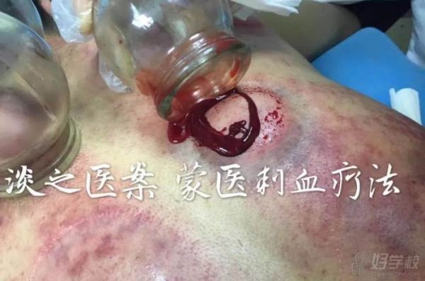 蒙医刺血疗法