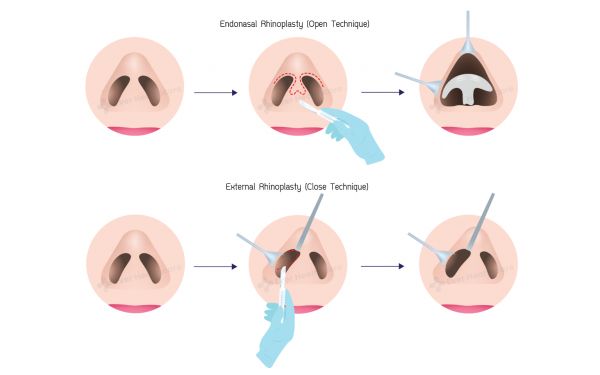 鼻整形手術(shù) - Fidel Clinic