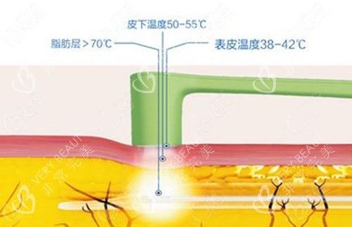 黃金微雕溶脂溫度