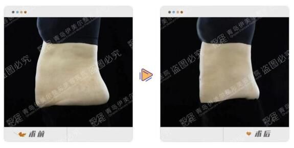 腰腹脂肪最難減，還好有青島伊美爾黃金微雕
