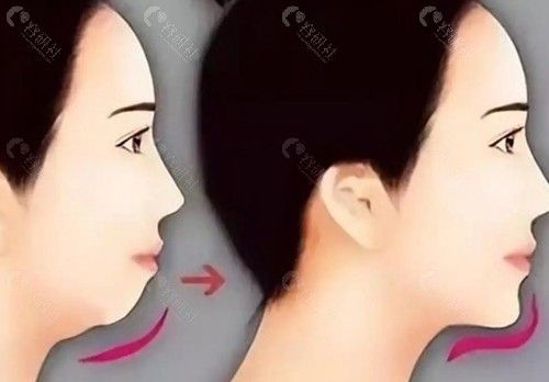 下巴填充手术价格一览表