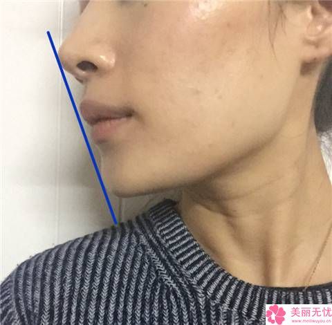 婁底下巴整形治療手術(shù)注意事項及適應(yīng)人群介紹