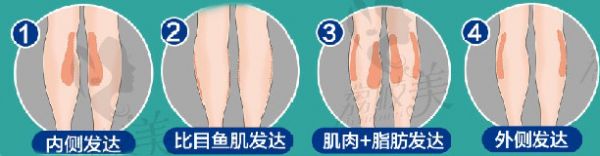 小腿粗 