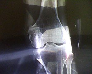 比较好用的增高产品是什么