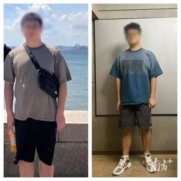 大學(xué)生減肥月瘦20斤卻得了重度脂肪肝