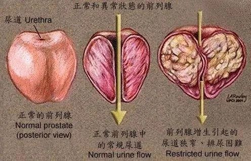 前列腺1.jpg