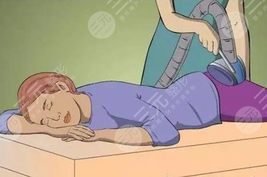 吸脂