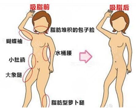 韓式共振吸脂減肥手術(shù)后9周