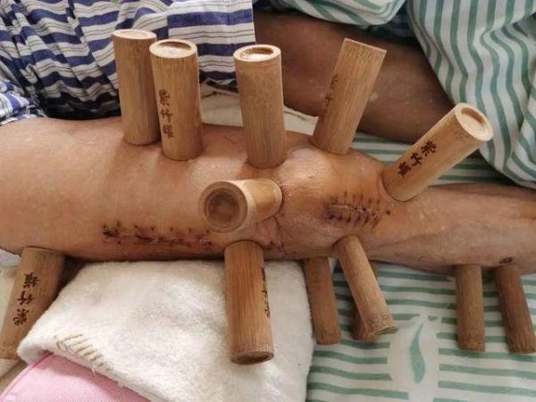 拔竹罐減肥效果如何，拔罐瘦身的原理是什么（省中醫(yī)中醫(yī)護(hù)理門診開展20余項(xiàng)護(hù)理技術(shù)）