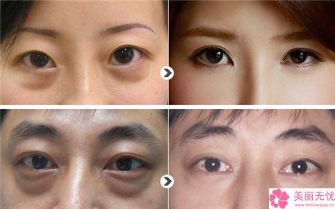 承德瀚美醫(yī)療美容機(jī)構(gòu)眼袋打溶脂手術(shù)一般價格是多少錢