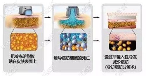 酷塑冷凍溶脂原理