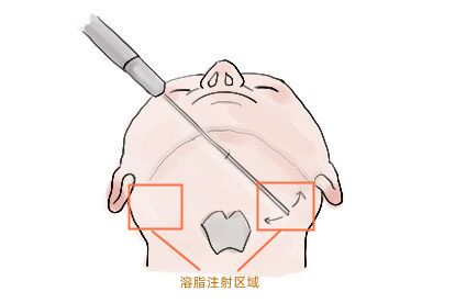 双下巴溶脂区域图