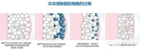 酷塑冷凍溶脂