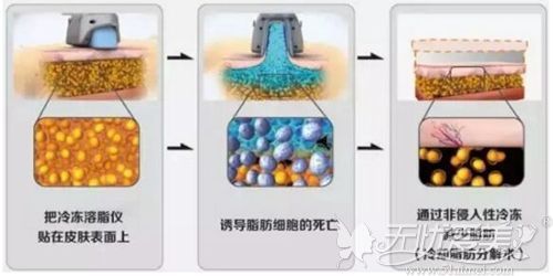沈陽酷塑冷凍溶脂原理