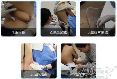 沈陽酷塑冷凍溶脂治療步驟