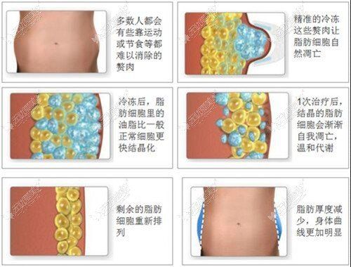 酷塑冷凍溶脂瘦腰效果圖
