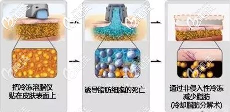 酷塑冷冻溶脂的效果