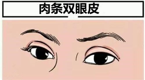 陳貴宗雙眼皮修復(fù)咋樣？肉條眼修復(fù)很自然費(fèi)用1.8萬起