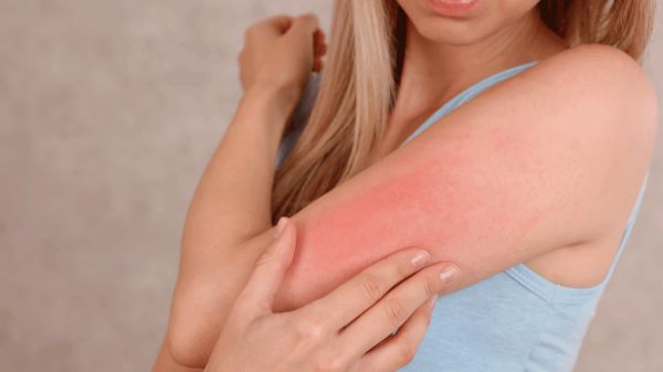mujer con piel del brazo irritada