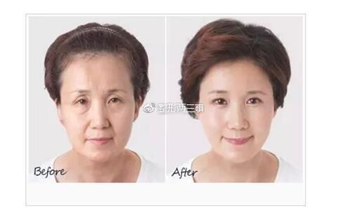 線雕鼻子多少錢 面部輪廓不同價(jià)格不一樣