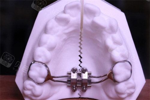 MSE扩弓器安装在牙模上