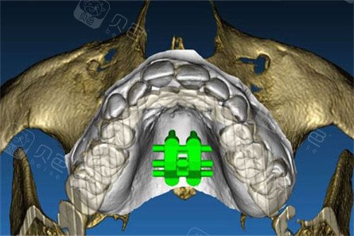 MSE扩弓器设计图