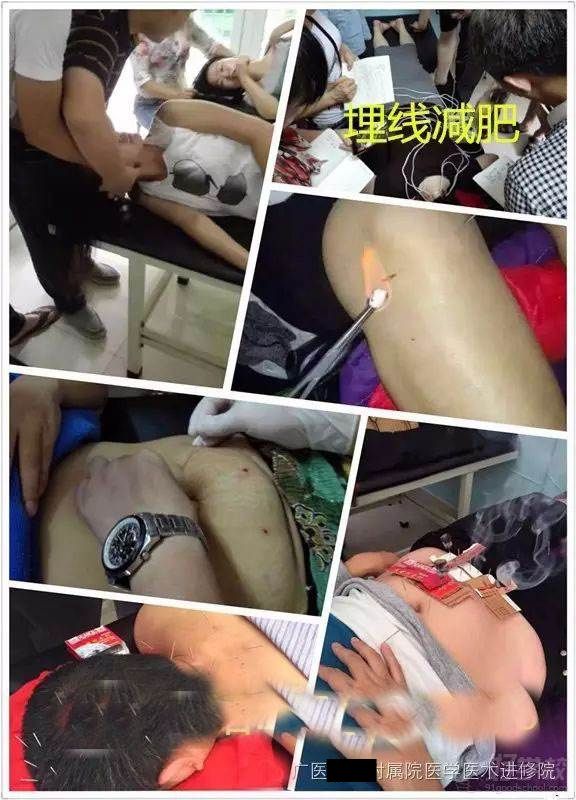 学员埋线减肥练习中