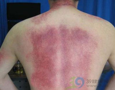 詳解:刮痧拔罐全過程(圖)