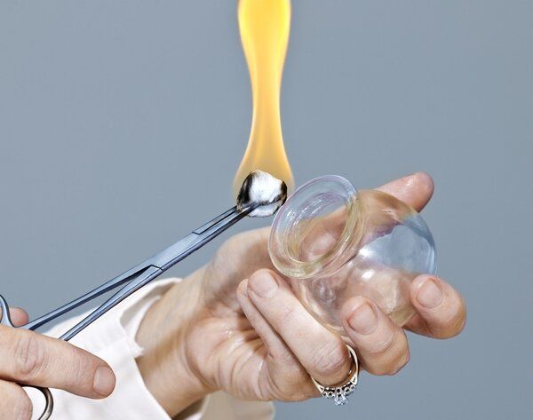 網(wǎng)友分享：我的拔罐減肥事跡