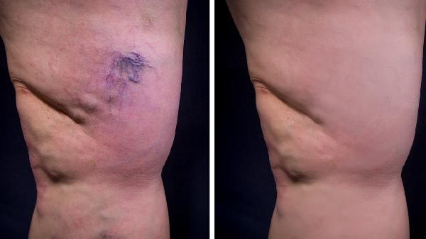 怎样选择瘦身霜可以让我们瘦的更快?