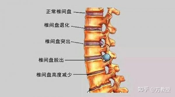 中醫(yī)懶人健康法之腰椎間盤突出3