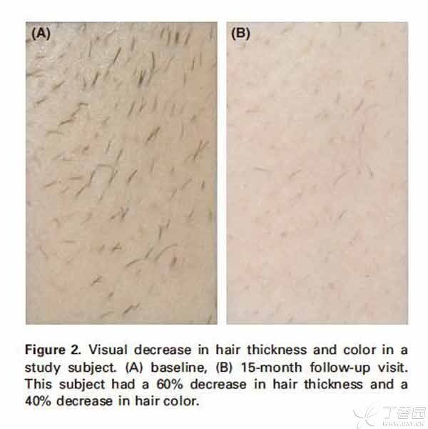【插图】激光脱毛-脱毛前后-600.jpg