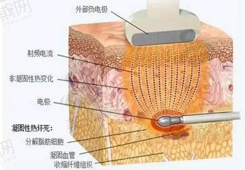 射頻溶脂和冷凍溶脂哪個好？二者優(yōu)缺點匯總