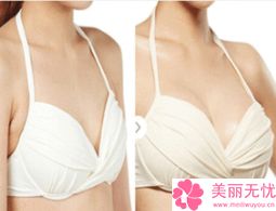 蚌埠美之美容整形外科诊所价格表重点推荐一览-自体丰胸修复手术案例