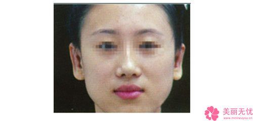 蚌埠医学院第二附属医院整形美容外科价格(价目)全新上市-手术再造耳案例
